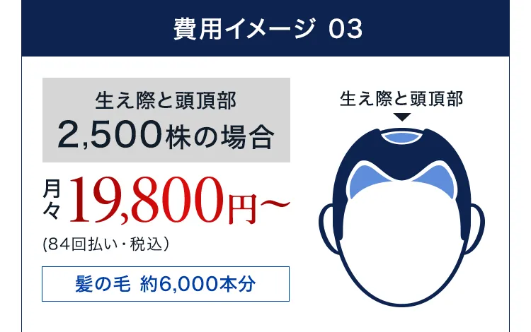 生え際と頭頂部2,500株の場合