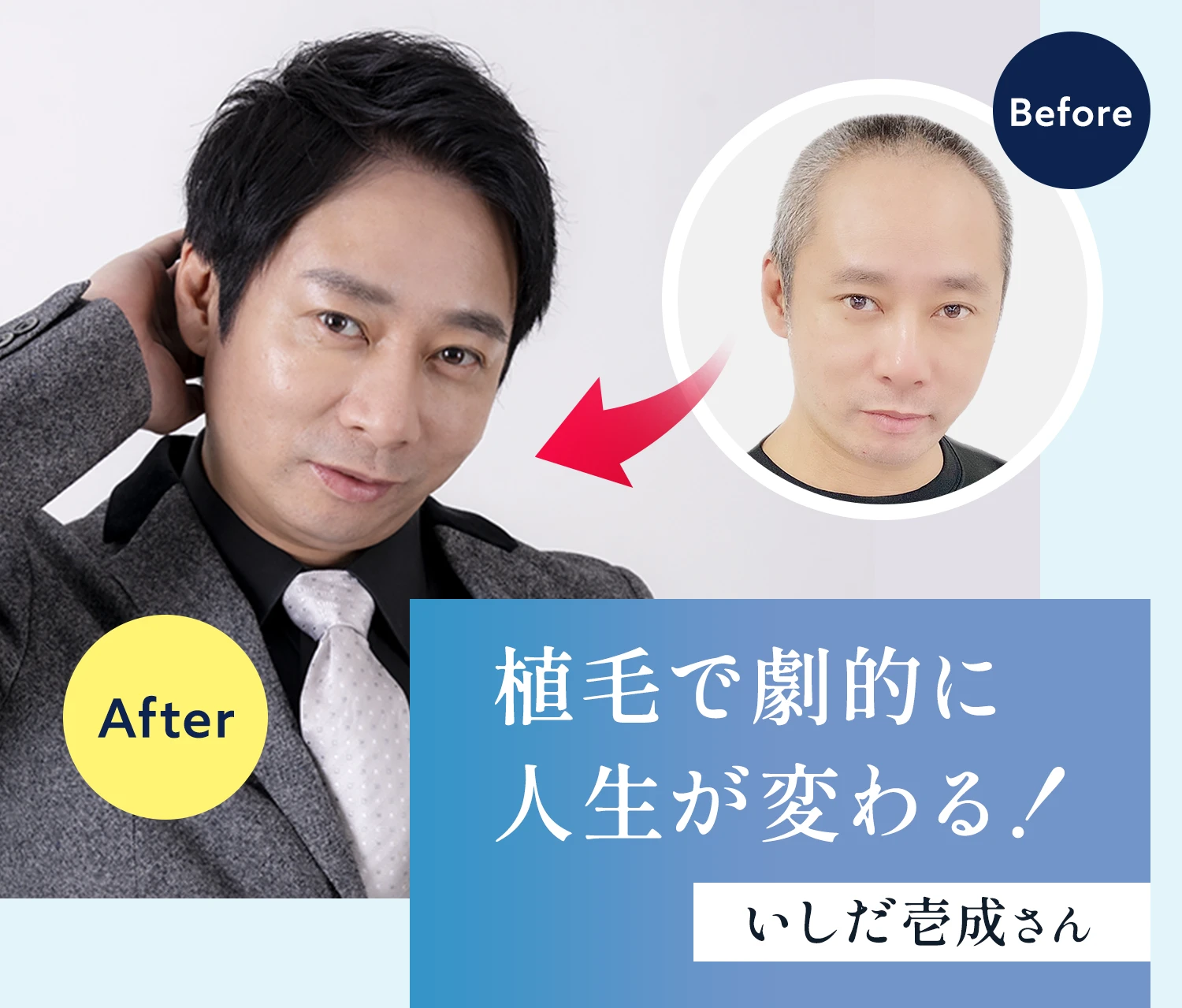 植毛で劇的に人生が変わる！