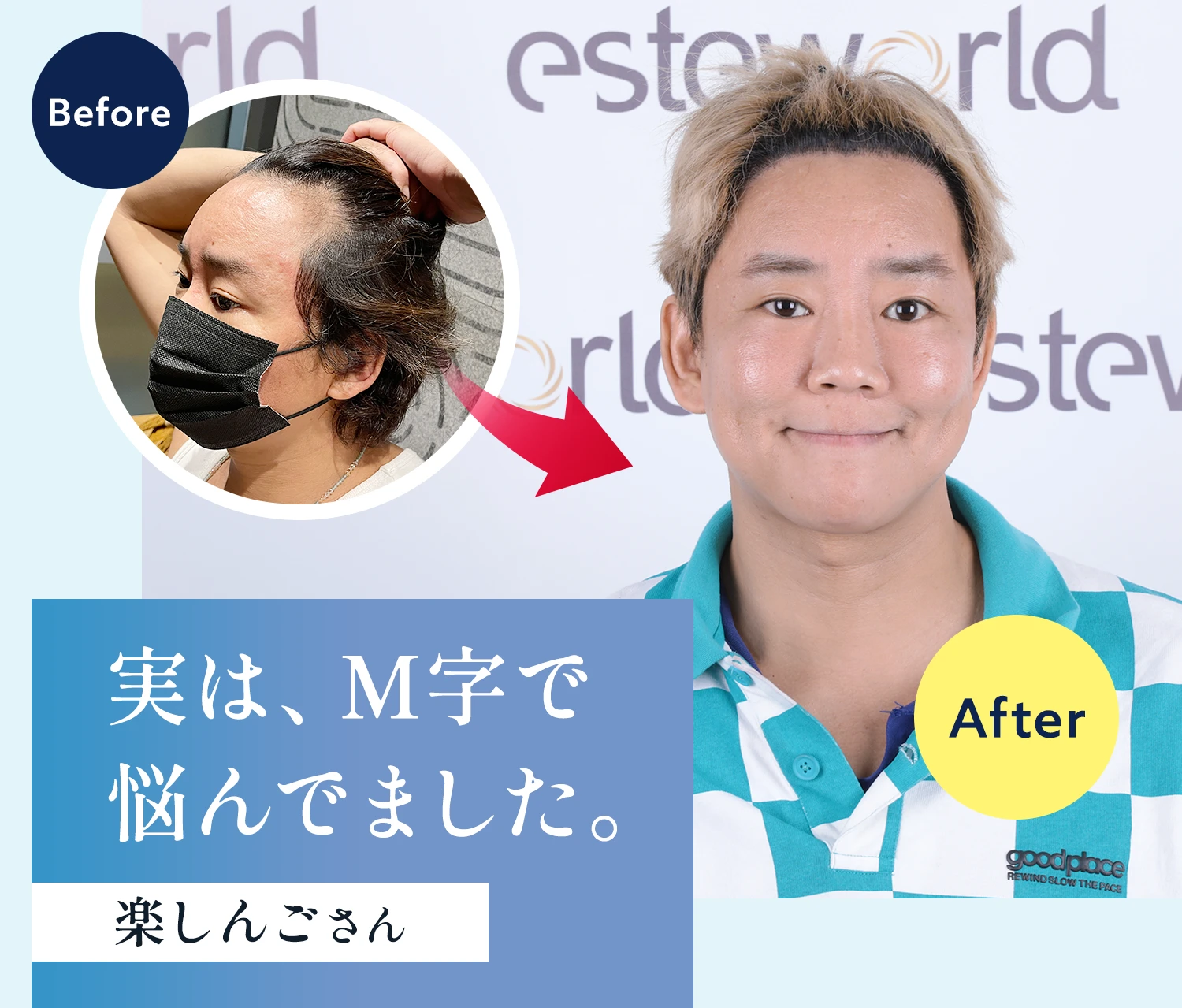 実は、M字で悩んでました。