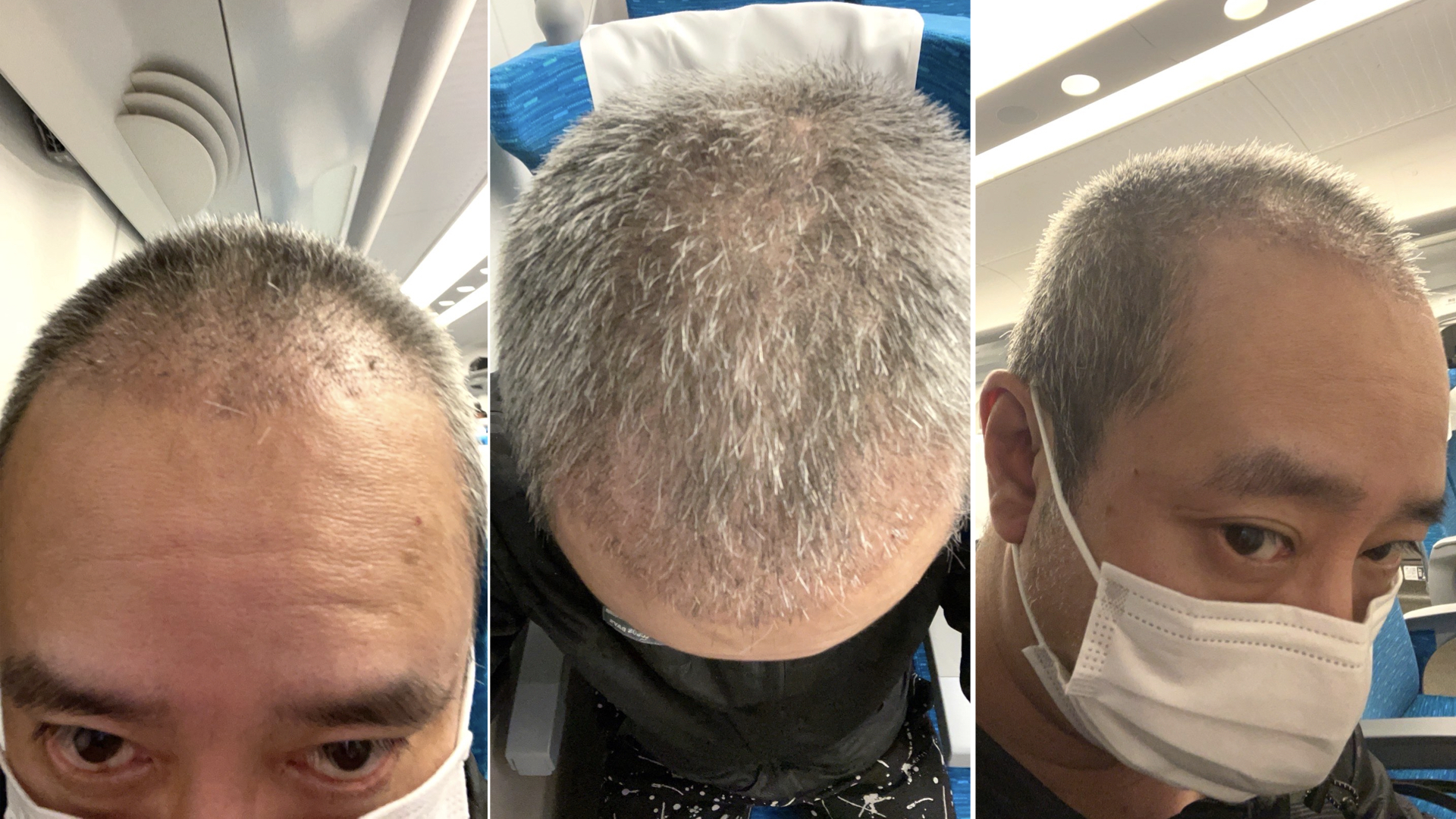 トルコ植毛から1ヶ月後