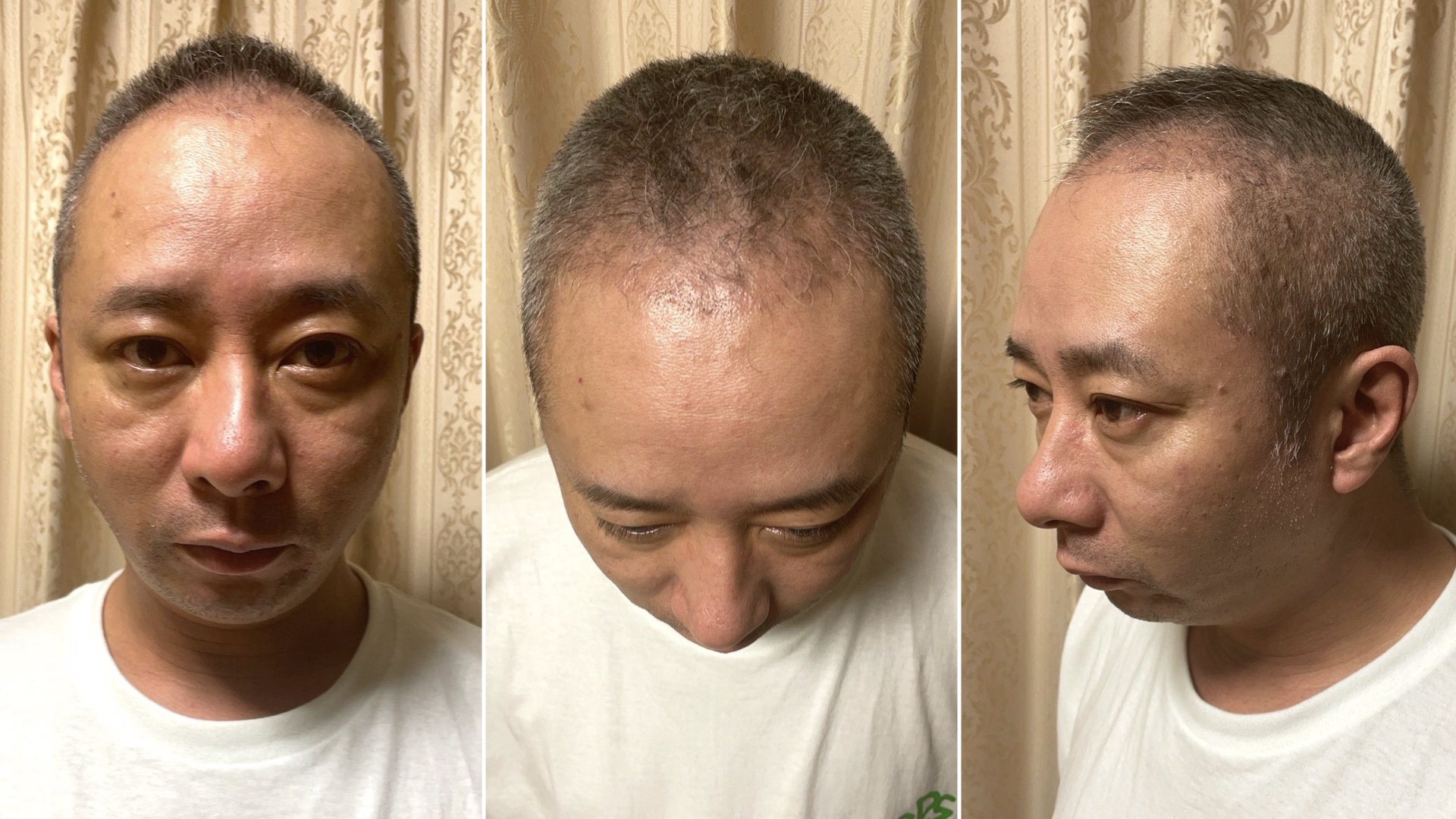 トルコ植毛から2ヶ月後